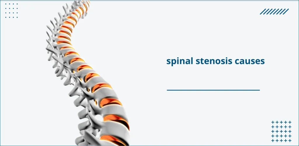 spinal stenosis causes